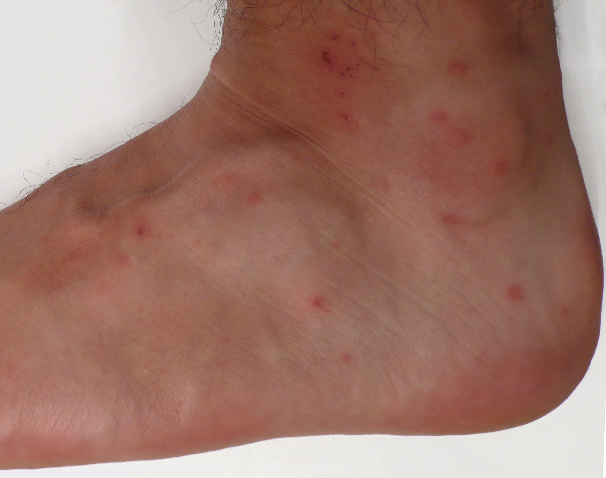 Piqûres d'aoûtats groupées sur la cheville et le pied, petits boutons rouges