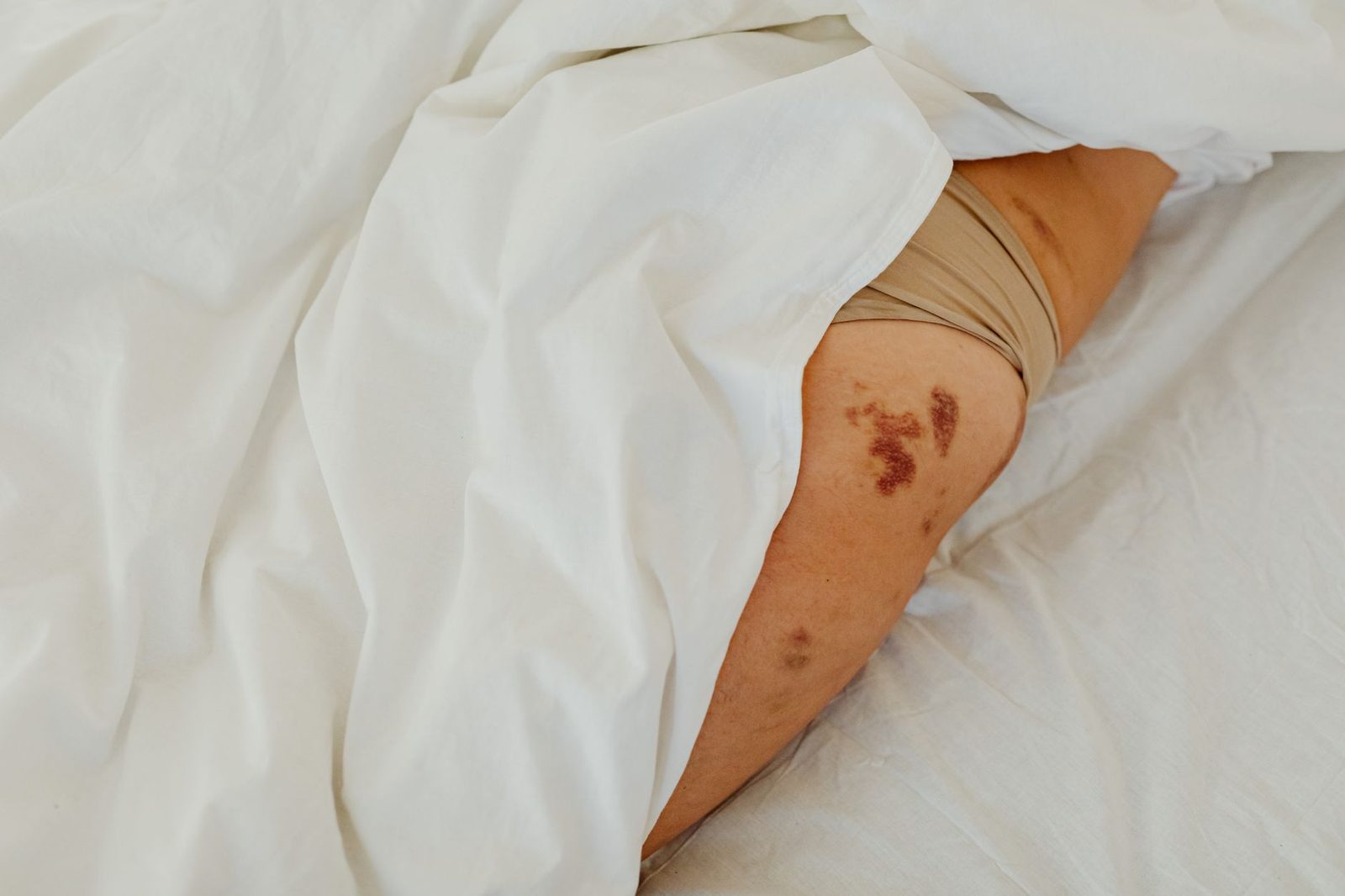 Jambe d'une personne allongée dans un lit blanc, portant des rougeurs et lésions cutanées évoquant des piqûres